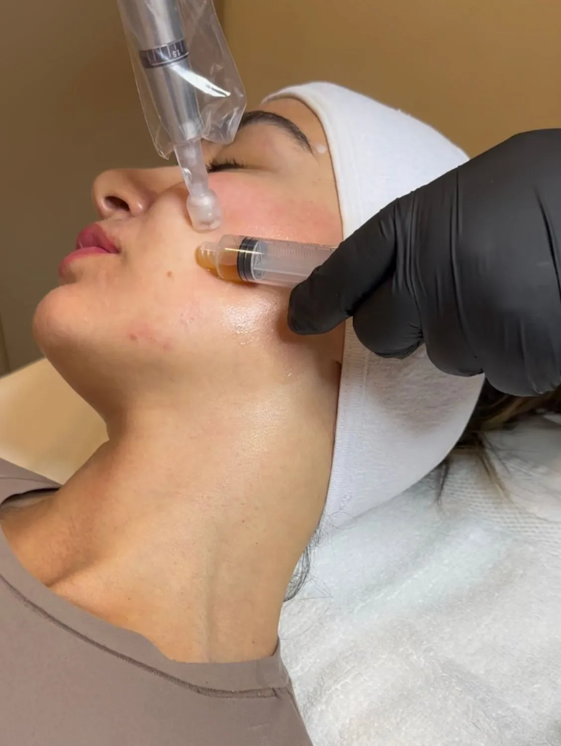 Burbank microneedling patient receiving treatment