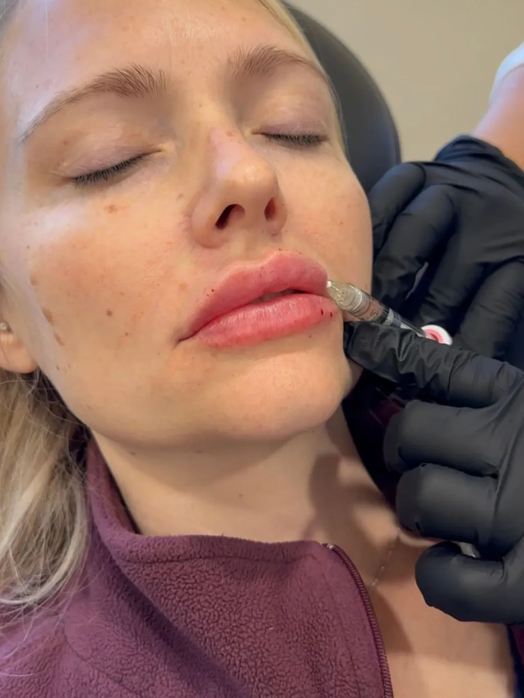 burbank dermal fillers patient receiving treatment