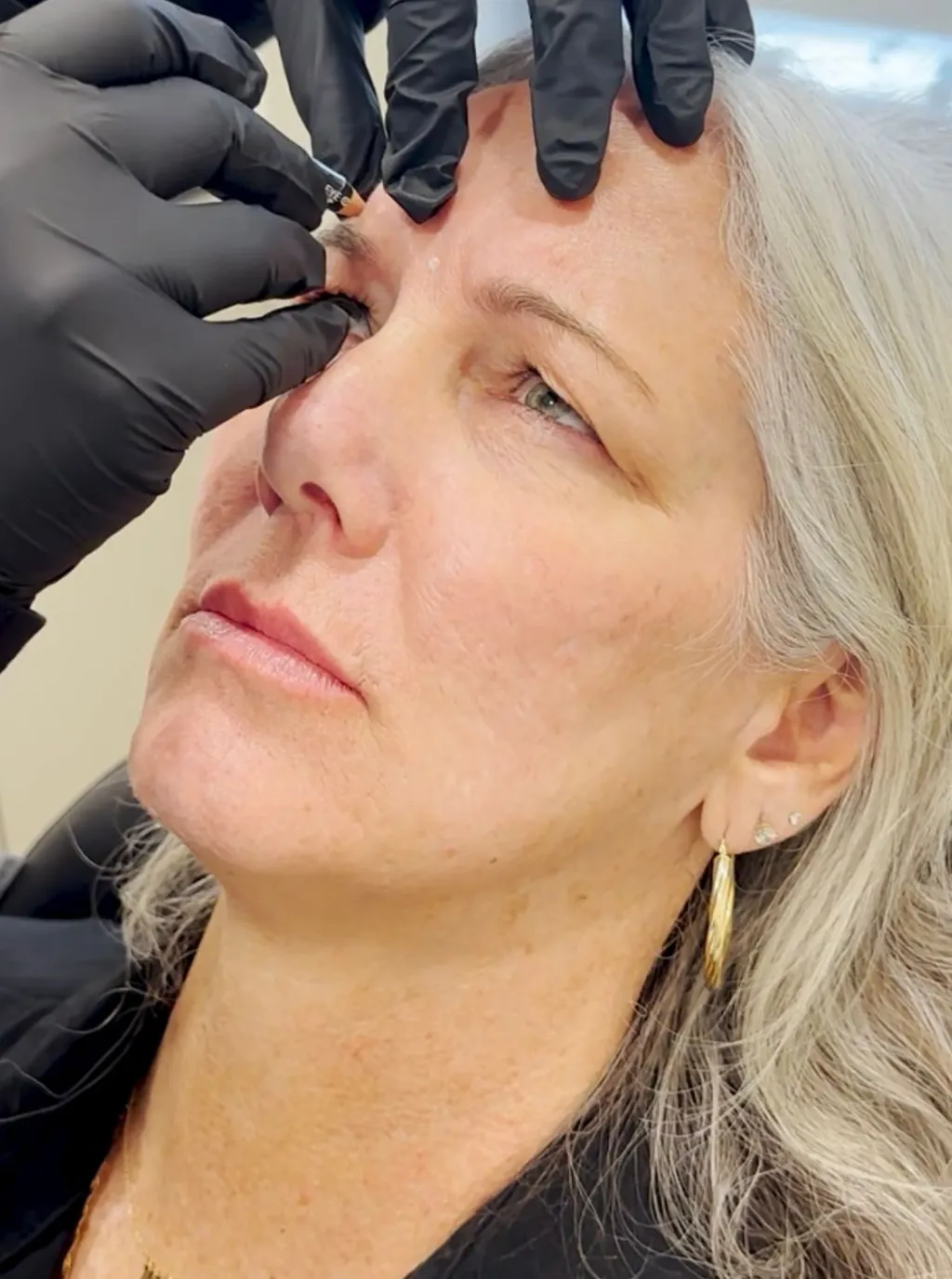 Burbank botox patient receiving treatment