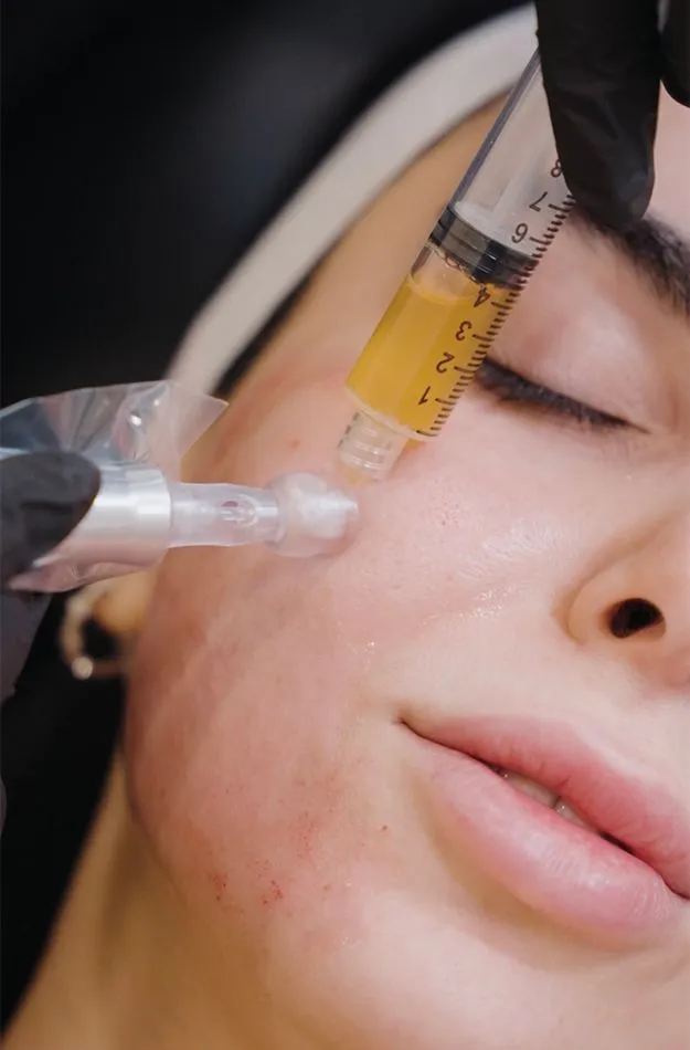 Burbank PRP Treatments model receiving treatment