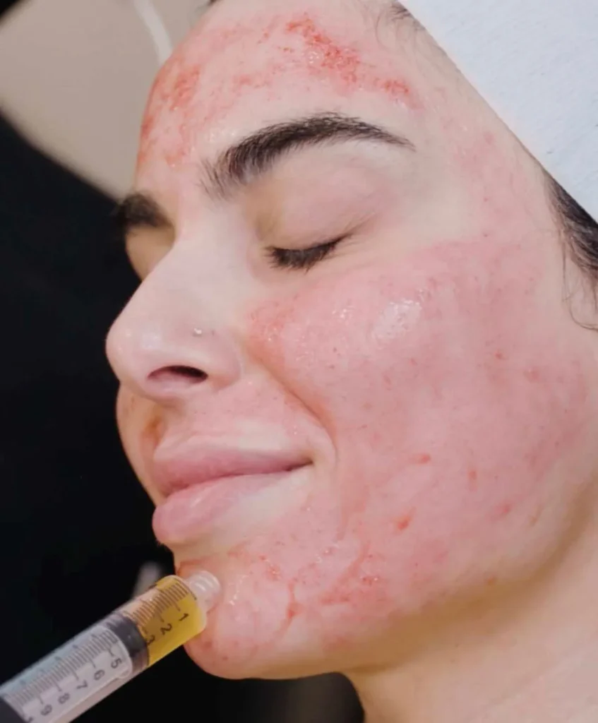 Microneedling
