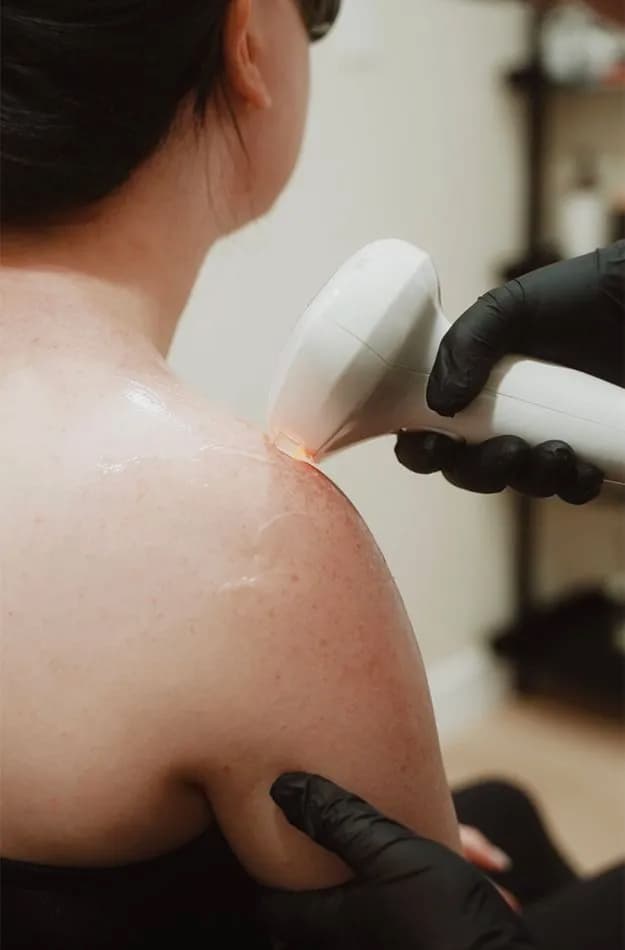 Laser hair removal