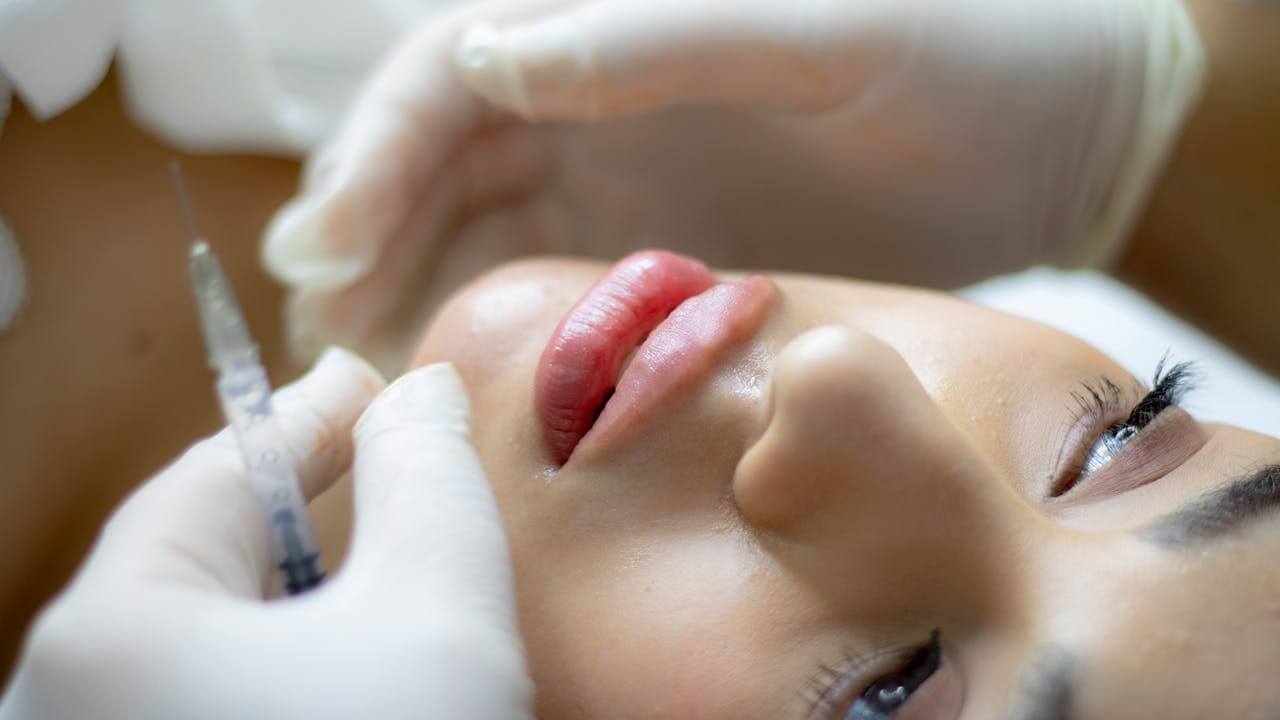 Lip filler
