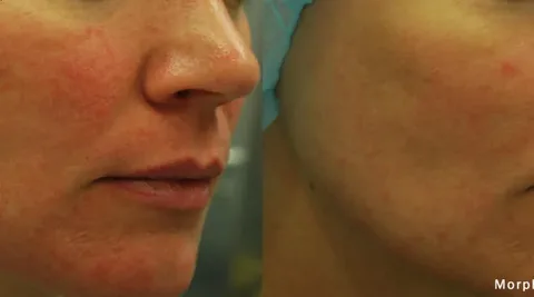 Skin tightning