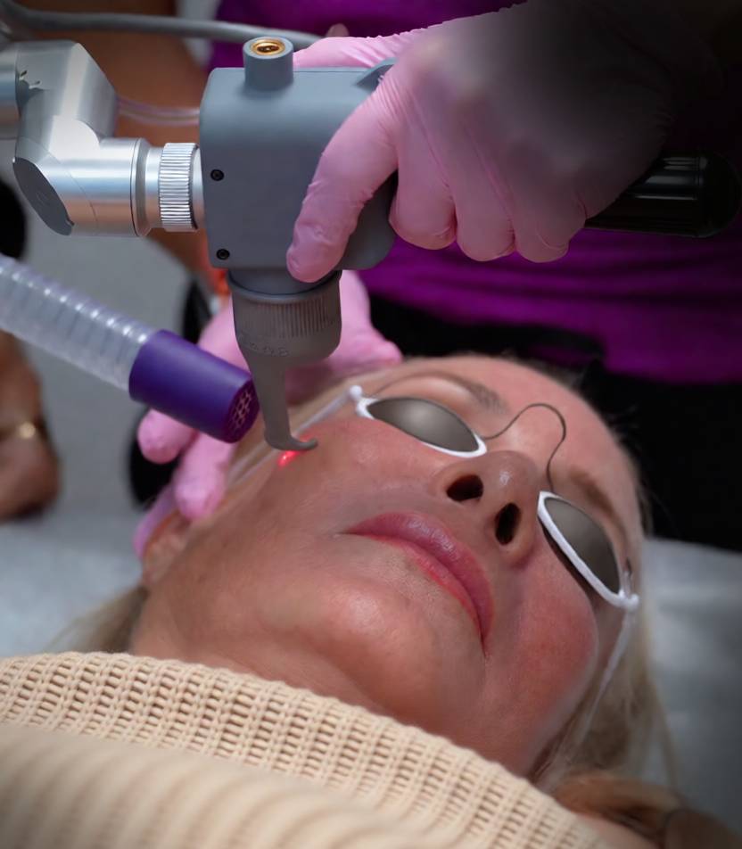 co2-laser-resurfacing-burbank