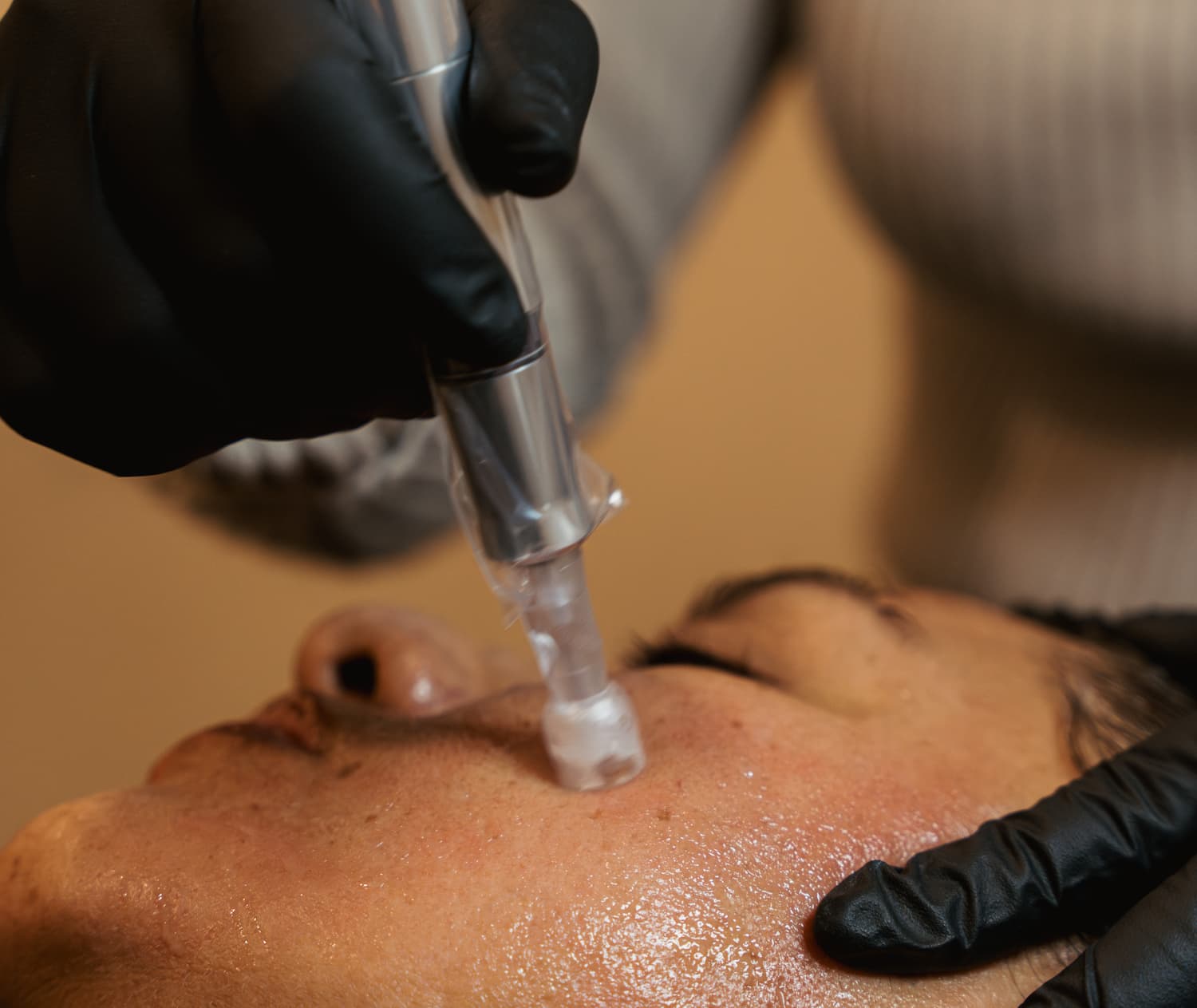 Microneedling