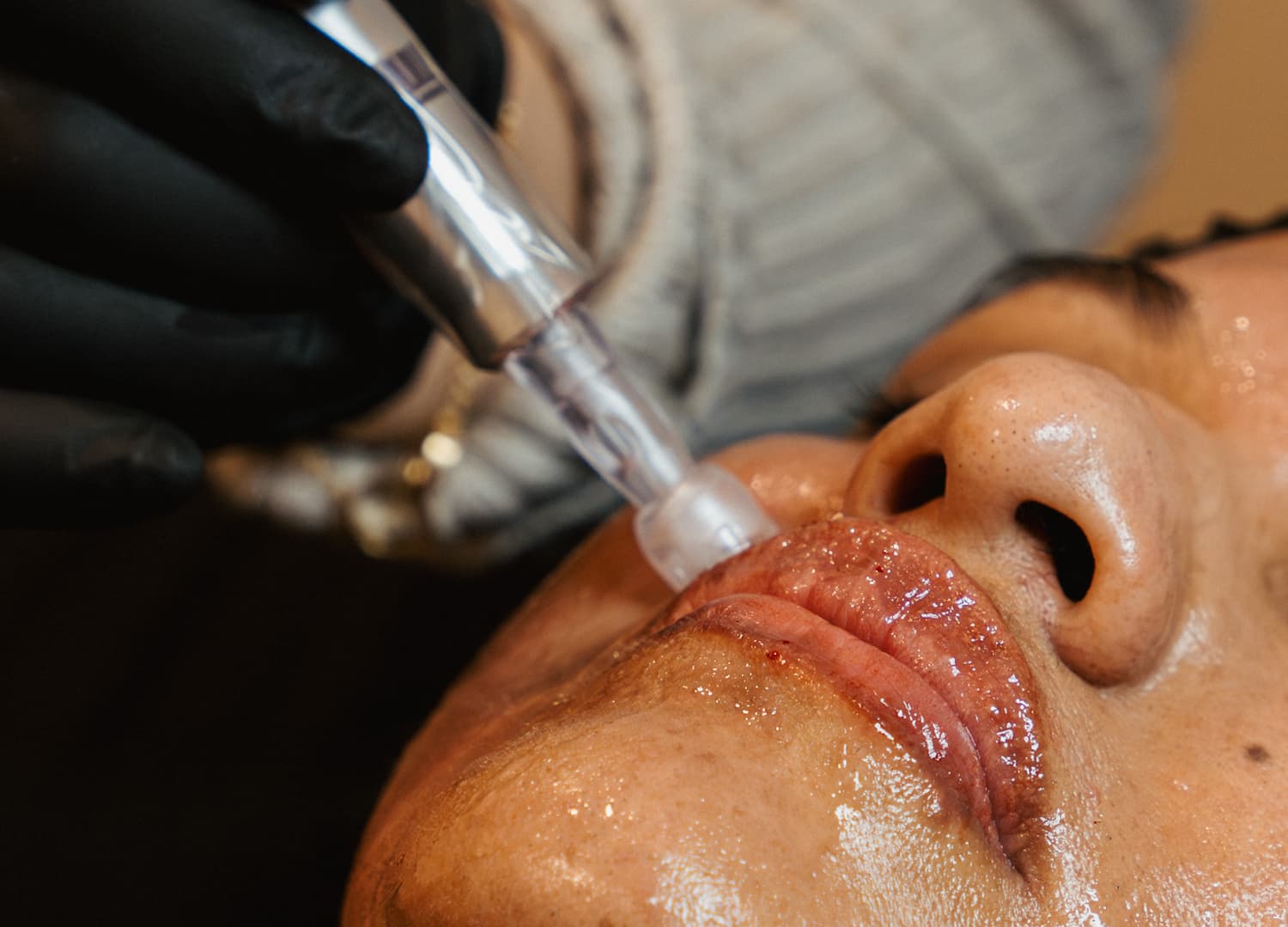 Microneedling