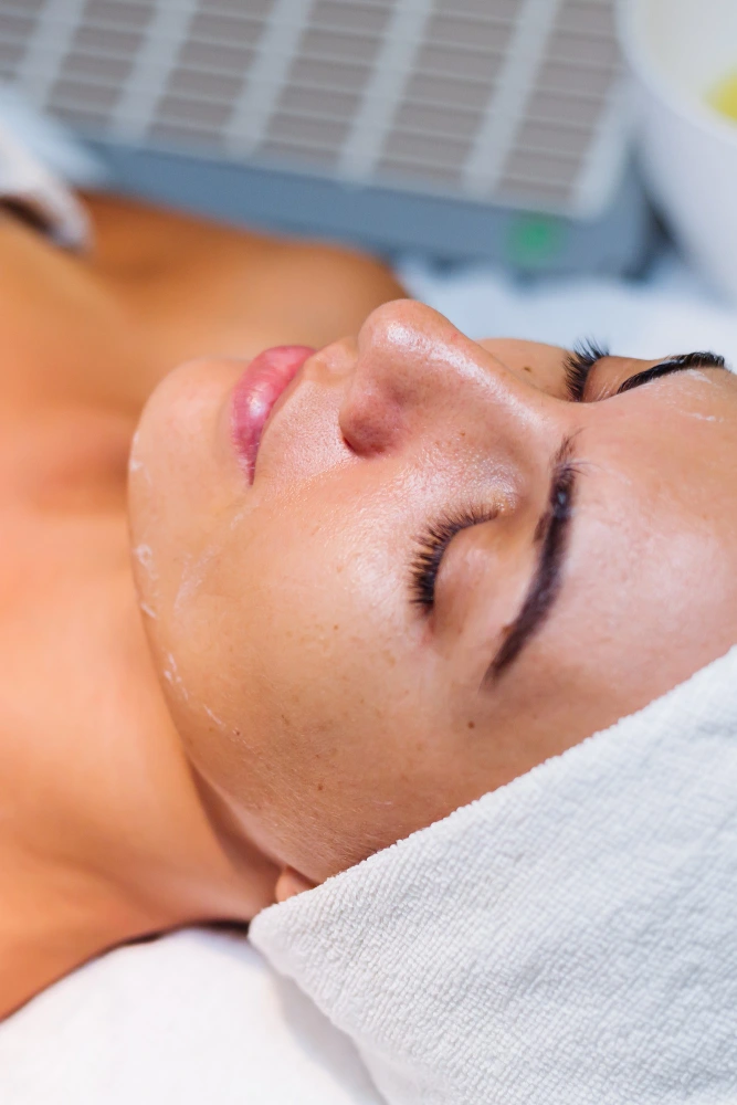 chemical peels